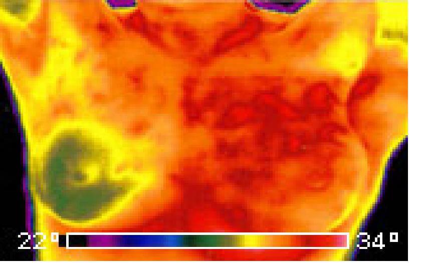 Infrared Thermal Imaging in Medical Diagnosis