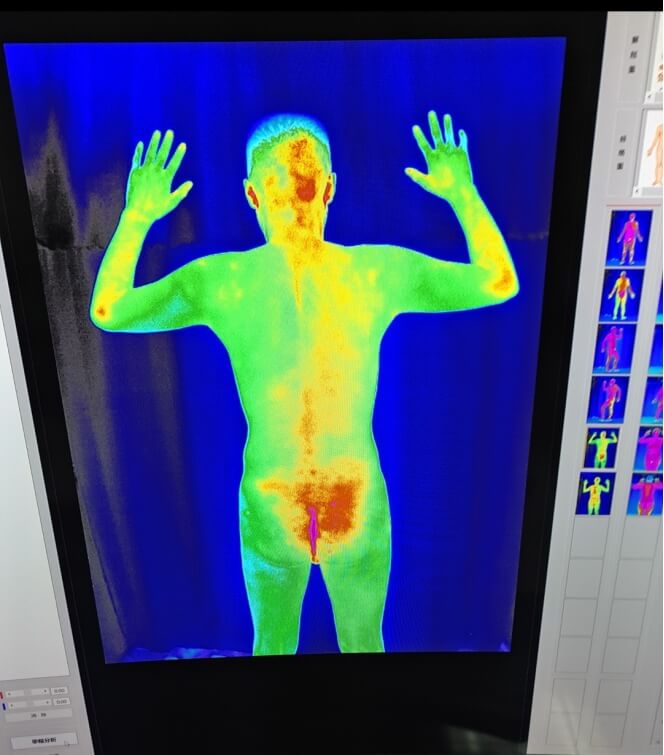 Infrared Thermal Imaging in Medical Diagnosis